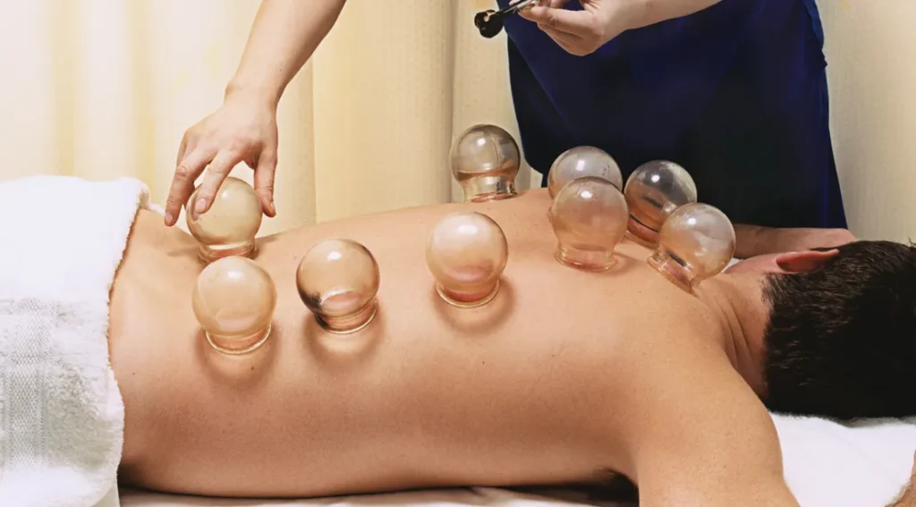 Cupping Therapy